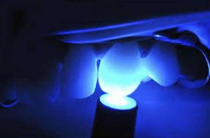 light cure تجهیزات دندانپزشکی